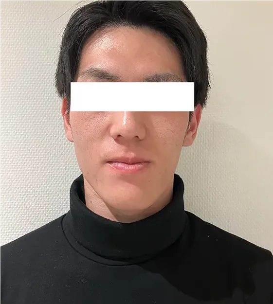 フェイスラインケアafter