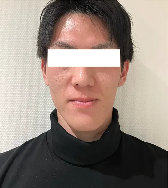 フェイスラインケアbefore