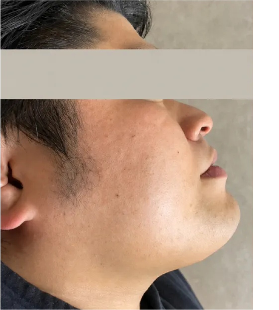 光フェイシャルafter