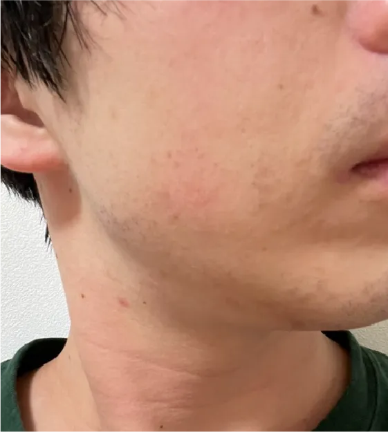 ヒゲ脱毛after