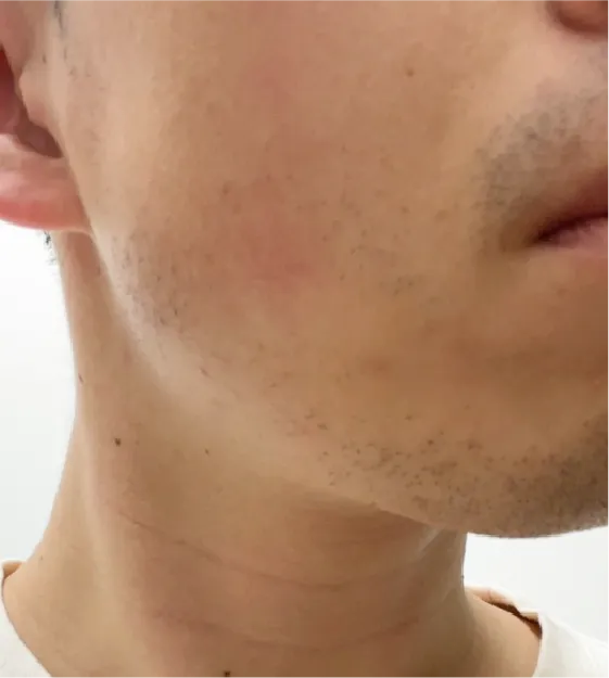 ヒゲ脱毛before