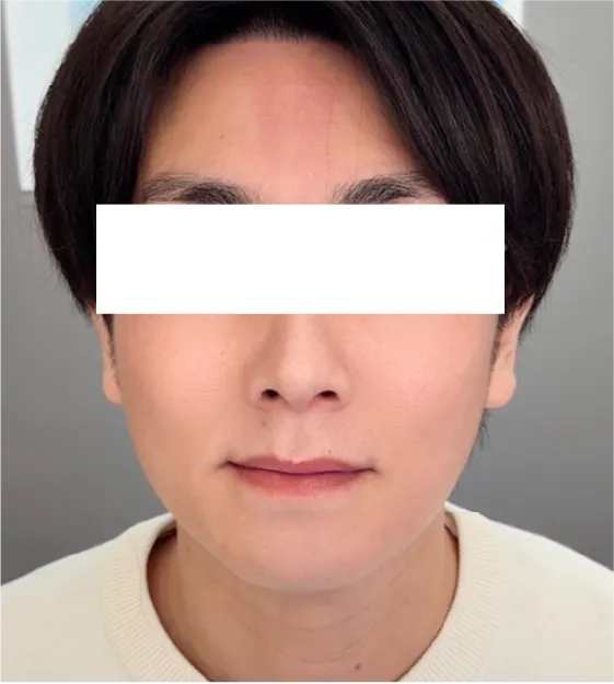 エステ版チタニウムリフトbefore