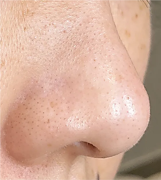 毛穴洗浄before