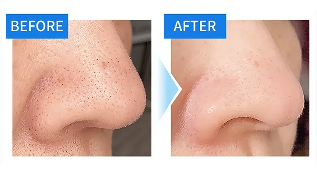 毛穴洗浄 症例１