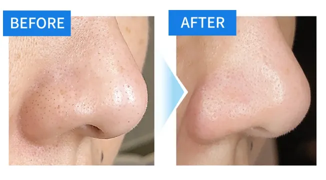 毛穴洗浄 症例１