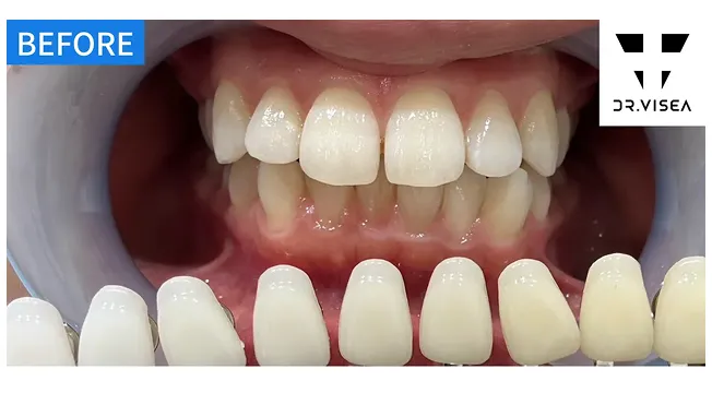 ホワイトニング 症例１