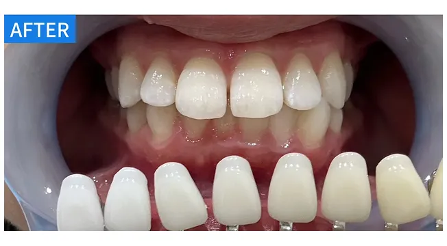 ホワイトニング 症例１