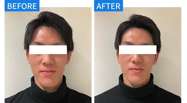 フェイスラインケア 症例１