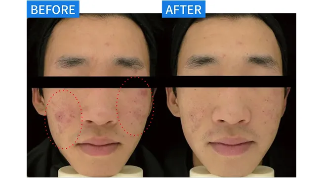 プラズマ導入 症例１