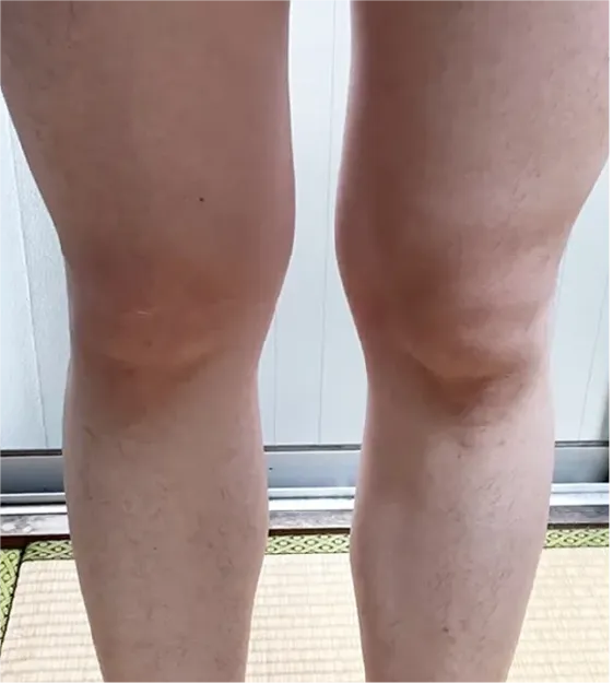 全身脱毛after