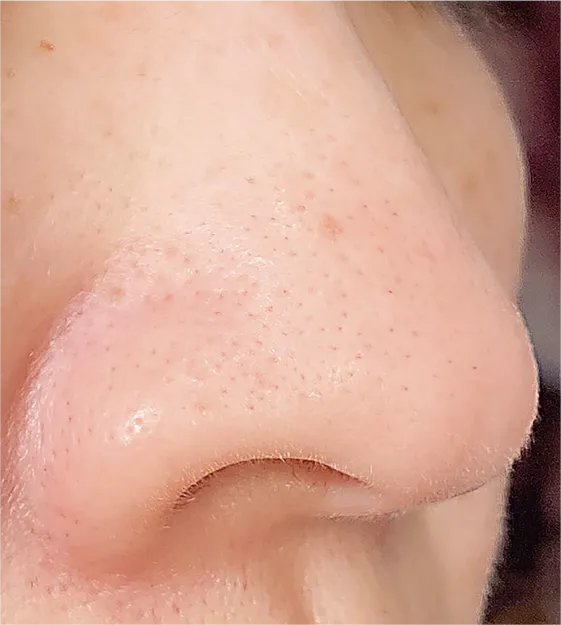 毛穴洗浄after