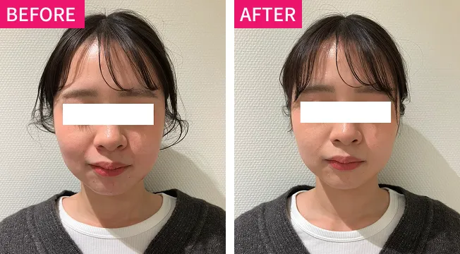 フェイスラインケア 症例１